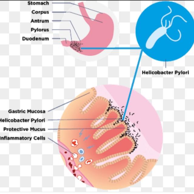 H pylori infection cure